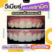 คลิกดู ครอบฟันและวีเนียร์เซรามิกสีเหมือนฟันระบบดิจิตัล