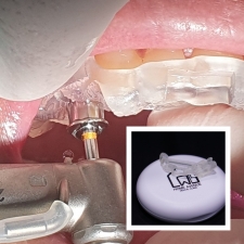 รากฟันเทียม 32900 บาท แถม Surgical Guide เพิ่มความปม่นยำในการรักษาฟรีไปอีก 