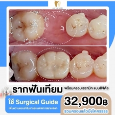 คลิกเพื่อดูเคสรากฟันเทียม